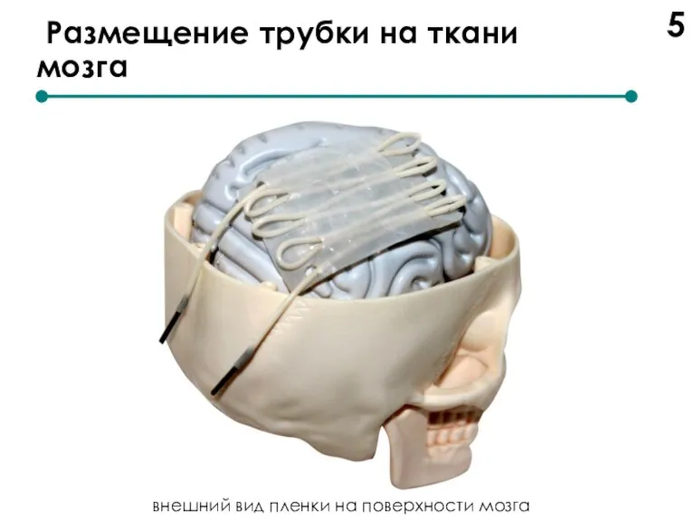 Размещение трубки на ткани мозга 5 внешний вид пленки на поверхности мозга
