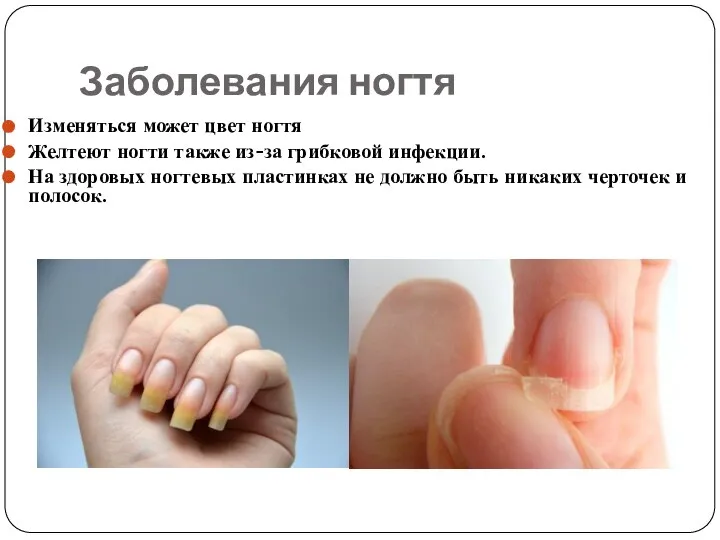 Заболевания ногтя Изменяться может цвет ногтя Желтеют ногти также из-за грибковой инфекции.
