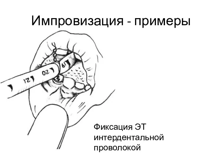 Импровизация - примеры Фиксация ЭТ интердентальной проволокой