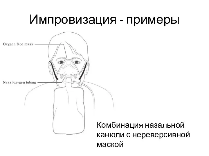 Импровизация - примеры Комбинация назальной канюли с нереверсивной маской