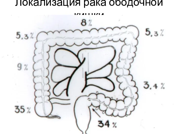 Локализация рака ободочной кишки