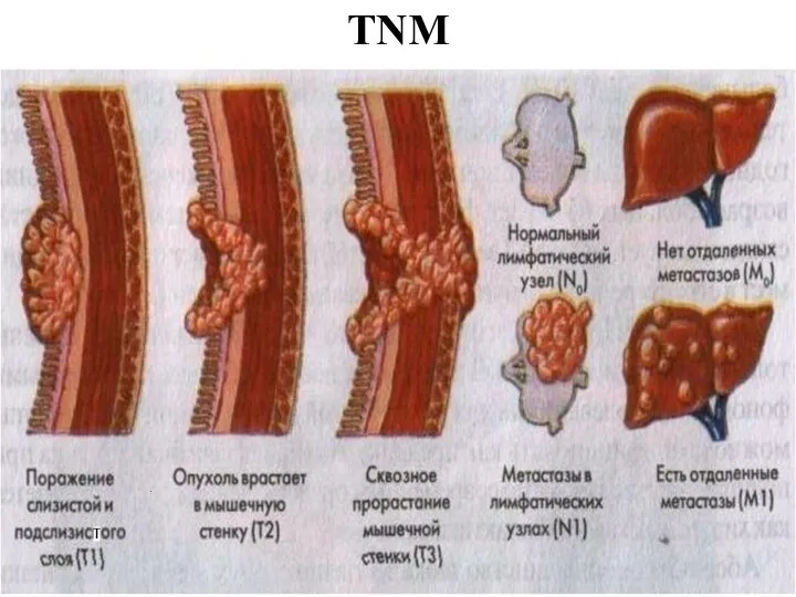 TNM