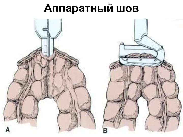 Аппаратный шов