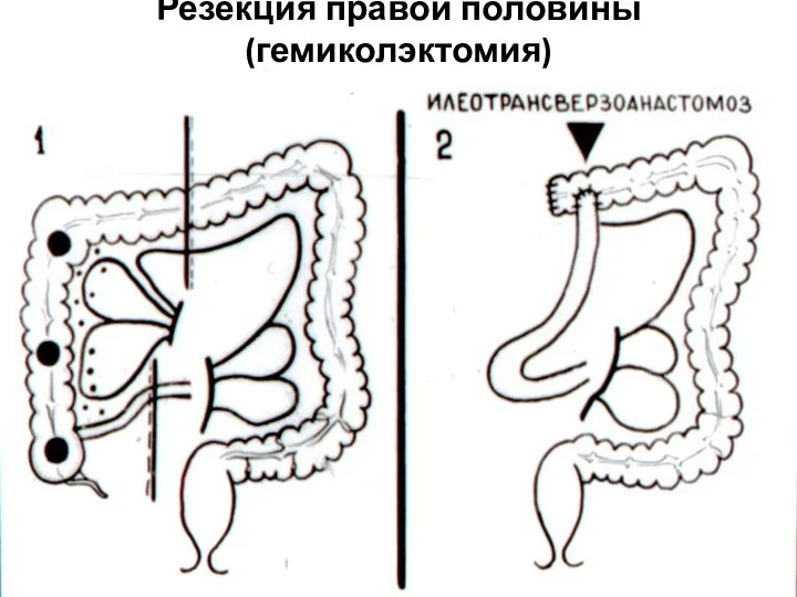 Резекция правой половины (гемиколэктомия)