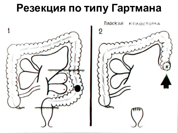 Резекция по типу Гартмана