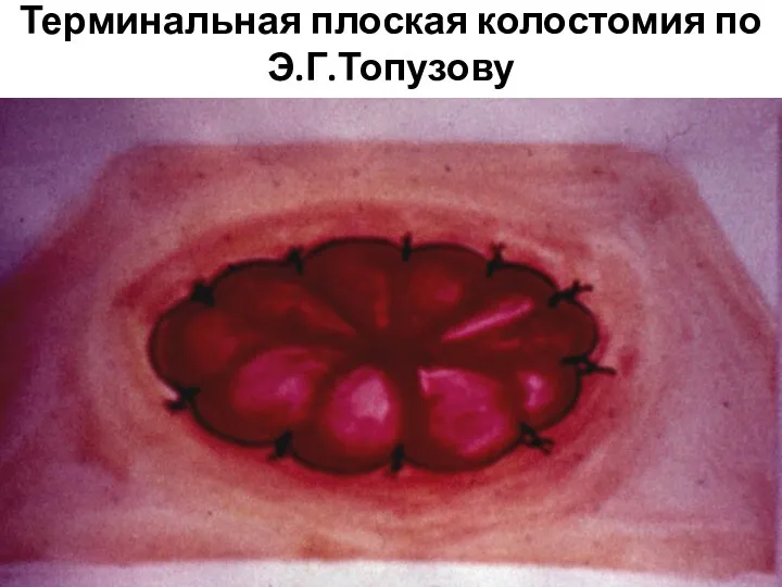 Терминальная плоская колостомия по Э.Г.Топузову