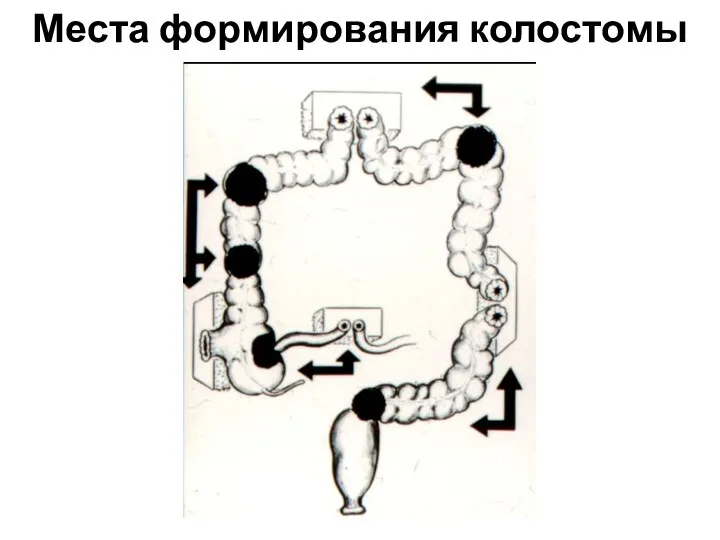 Места формирования колостомы