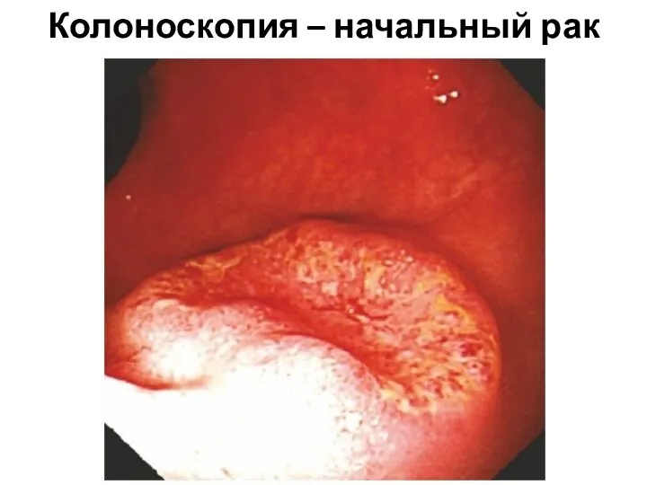 Колоноскопия – начальный рак