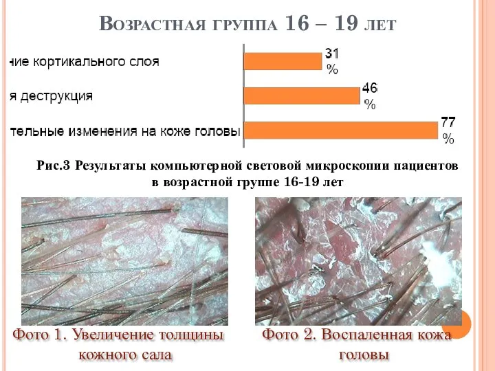 Фото 2. Воспаленная кожа головы Фото 1. Увеличение толщины кожного сала Возрастная