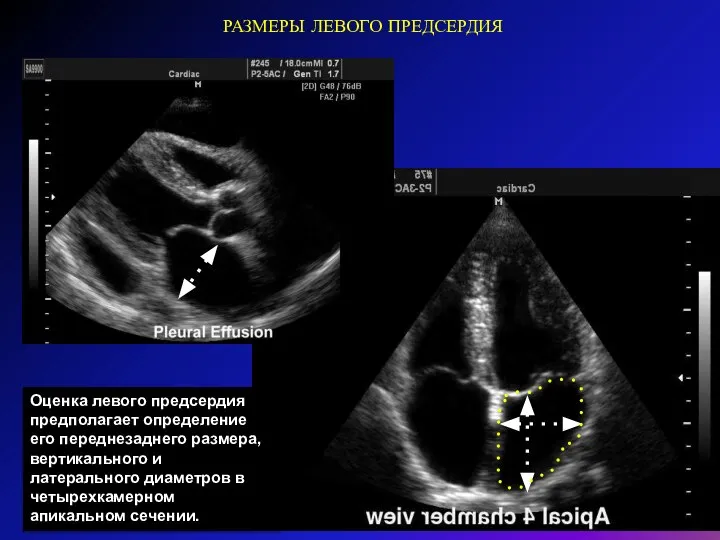 РАЗМЕРЫ ЛЕВОГО ПРЕДСЕРДИЯ Оценка левого предсердия предполагает определение его переднезаднего размера, вертикального
