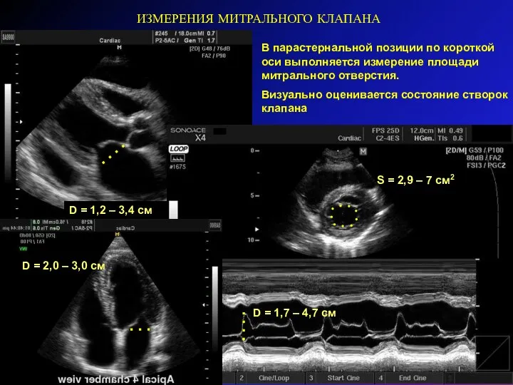 ИЗМЕРЕНИЯ МИТРАЛЬНОГО КЛАПАНА В парастернальной позиции по короткой оси выполняется измерение площади