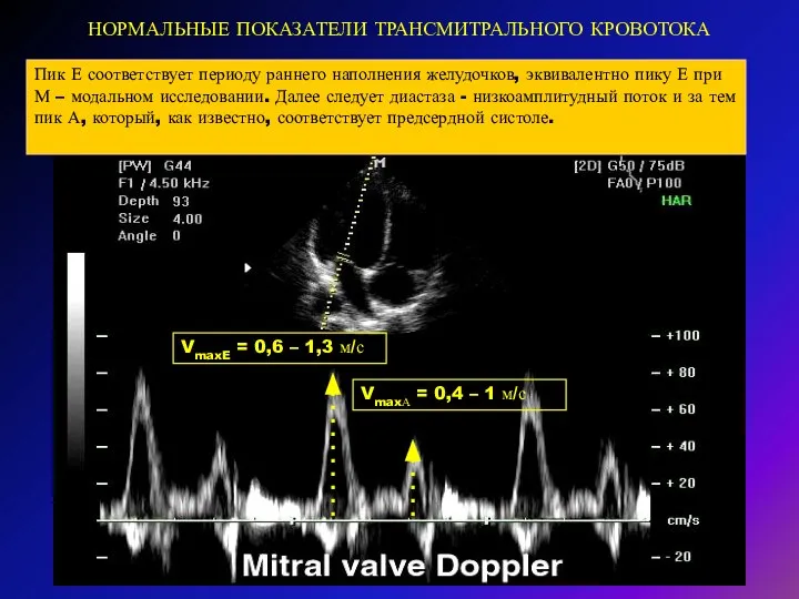 НОРМАЛЬНЫЕ ПОКАЗАТЕЛИ ТРАНСМИТРАЛЬНОГО КРОВОТОКА Пик Е соответствует периоду раннего наполнения желудочков, эквивалентно