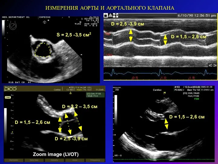 ИЗМЕРЕНИЯ АОРТЫ И АОРТАЛЬНОГО КЛАПАНА S = 2,5 -3,5 см2 D = 1,5 – 2,6 см