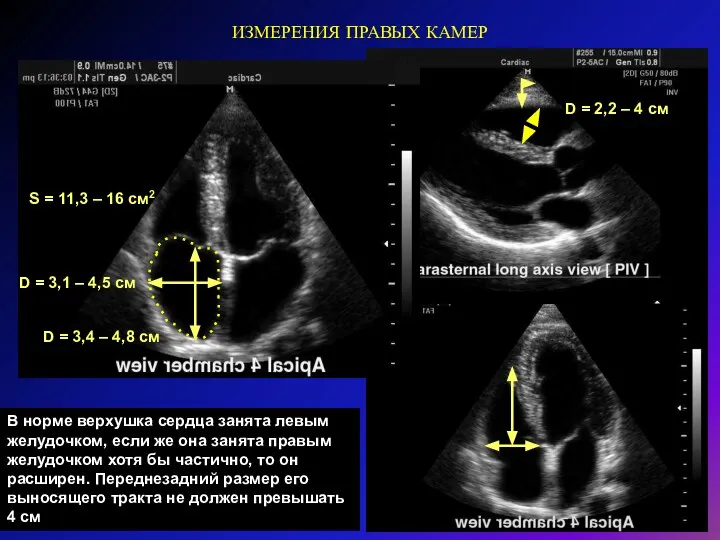 ИЗМЕРЕНИЯ ПРАВЫХ КАМЕР D = 2,2 – 4 см В норме верхушка