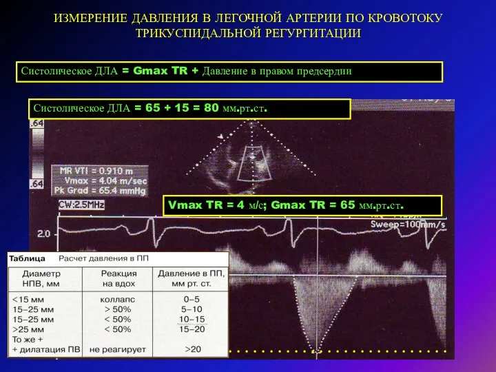 ИЗМЕРЕНИЕ ДАВЛЕНИЯ В ЛЕГОЧНОЙ АРТЕРИИ ПО КРОВОТОКУ ТРИКУСПИДАЛЬНОЙ РЕГУРГИТАЦИИ Систолическое ДЛА =