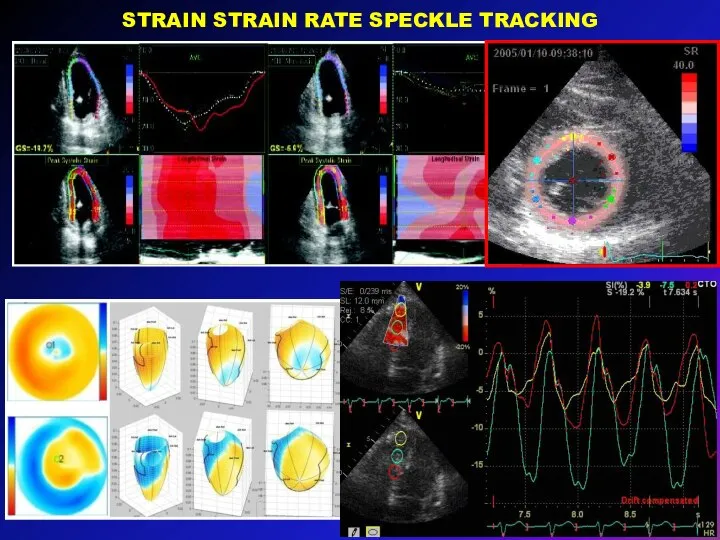 STRAIN STRAIN RATE SPECKLE TRACKING