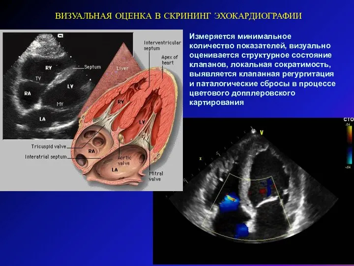 Измеряется минимальное количество показателей, визуально оценивается структурное состояние клапанов, локальная сократимость, выявляется