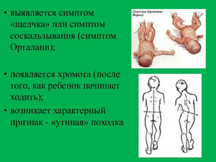 выявляется симптом «щелчка» или симптом соскальзывания (симптом Орталани); появляется хромота (после того,