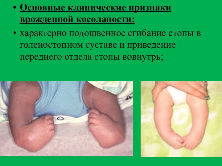 Основные клинические признаки врожденной косолапости: характерно подошвенное сгибание стопы в голеностопном суставе