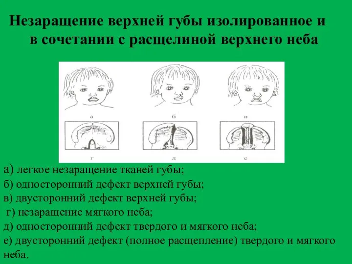 Незаращение верхней губы изолированное и в сочетании с расщелиной верхнего неба а)