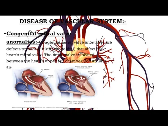DISEASE OF VASCULAR SYSTEM:- Congenital mitral valve anomalies:-Congenital mitral valve anomalies are