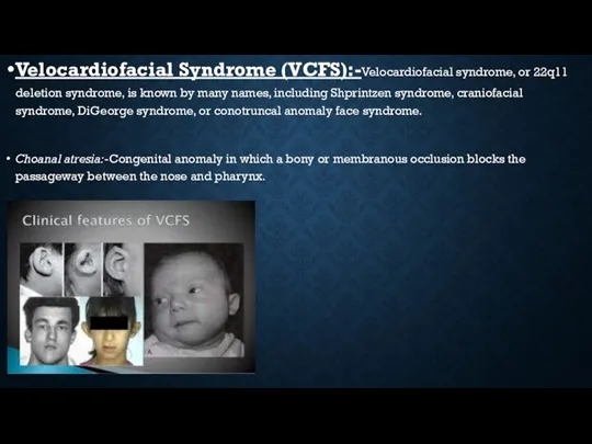 Velocardiofacial Syndrome (VCFS):-Velocardiofacial syndrome, or 22q11 deletion syndrome, is known by many