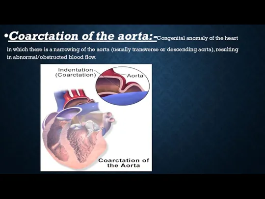 Coarctation of the aorta:-Congenital anomaly of the heart in which there is