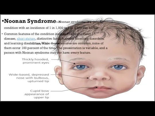 Noonan Syndrome:-Noonan syndrome is a genetic condition with an incidence of 1