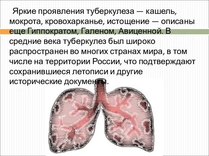 Яркие проявления туберкулеза — кашель, мокрота, кровохарканье, истощение — описаны еще Гиппократом,