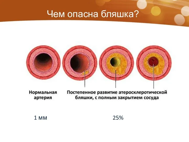 Чем опасна бляшка? 1 мм 25%