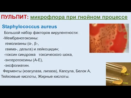ПУЛЬПИТ: микрофлора при гнойном процессе Staphylococcus aureus Большой набор факторов вирулентности: -Мембранотоксины: