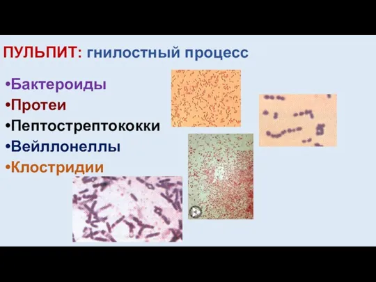 ПУЛЬПИТ: гнилостный процесс Бактероиды Протеи Пептострептококки Вейллонеллы Клостридии