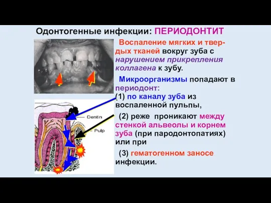 Одонтогенные инфекции: ПЕРИОДОНТИТ Воспаление мягких и твер- дых тканей вокруг зуба с