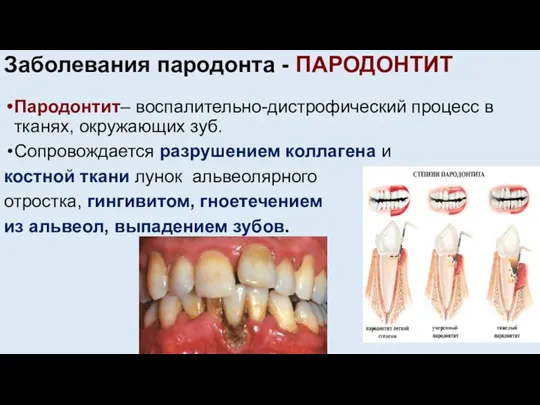 Заболевания пародонта - ПАРОДОНТИТ Пародонтит– воспалительно-дистрофический процесс в тканях, окружающих зуб. Сопровождается
