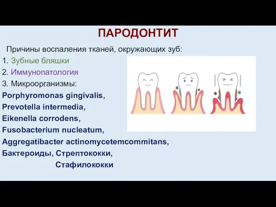 ПАРОДОНТИТ Причины воспаления тканей, окружающих зуб: 1. Зубные бляшки 2. Иммунопатология 3.