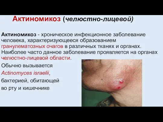 Актиномикоз (челюстно-лицевой) Актиномикоз - хроническое инфекционное заболевание человека, характеризующееся образованием гранулематозных очагов