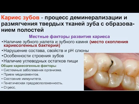 Кариес зубов - процесс деминерализации и размягчения твердых тканей зуба с образова-нием