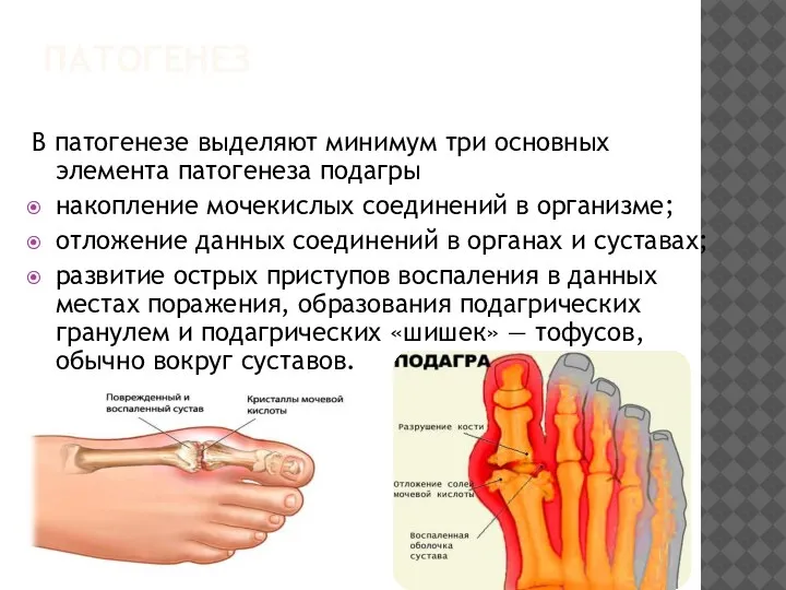 ПАТОГЕНЕЗ В патогенезе выделяют минимум три основных элемента патогенеза подагры накопление мочекислых