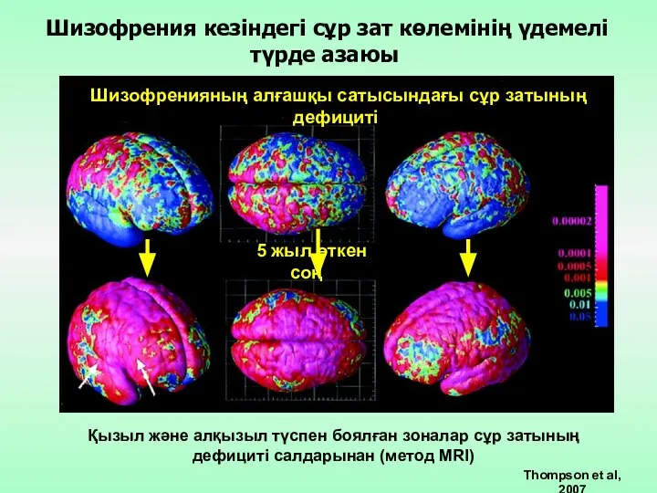 Қызыл және алқызыл түспен боялған зоналар сұр затының дефициті салдарынан (метод MRI)