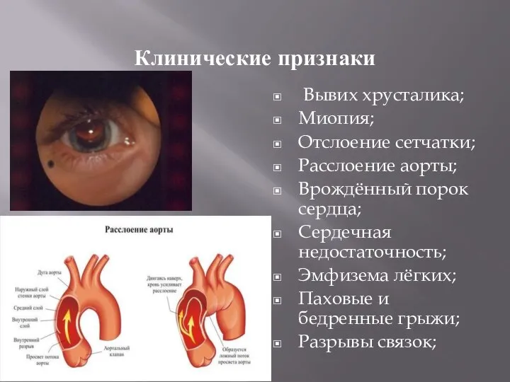 Клинические признаки Вывих хрусталика; Миопия; Отслоение сетчатки; Расслоение аорты; Врождённый порок сердца;