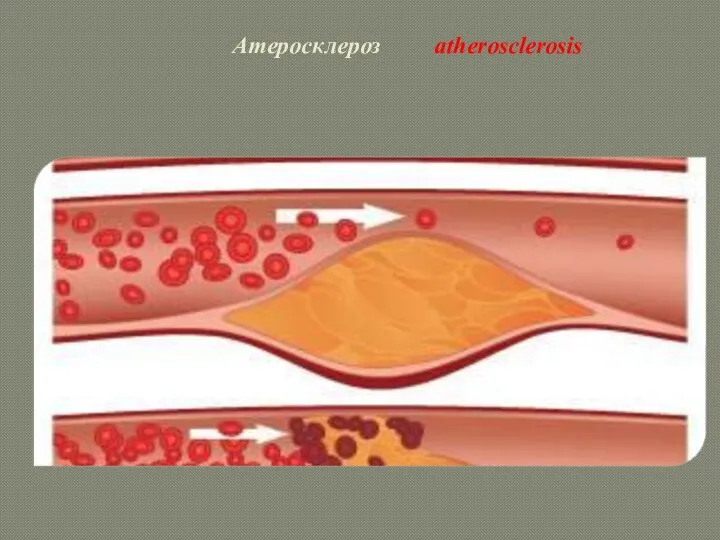 Атеросклероз atherosclerosis