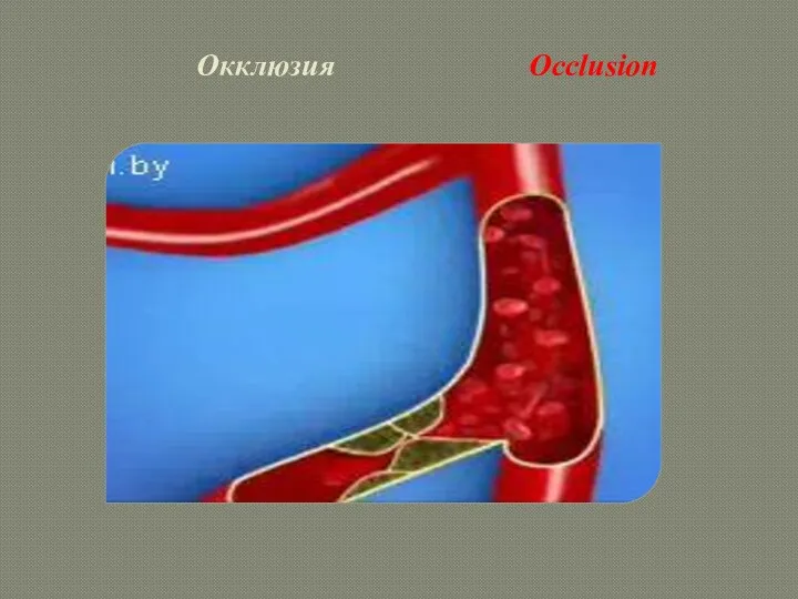 Окклюзия Occlusion