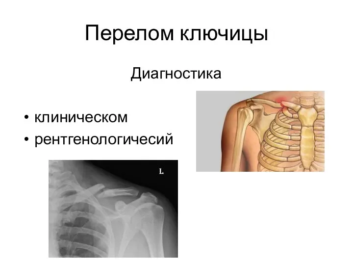 Перелом ключицы Диагностика клиническом рентгенологичесий