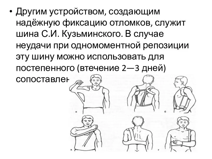 Другим устройством, создающим надёжную фиксацию отломков, служит шина С.И. Кузьминского. В случае