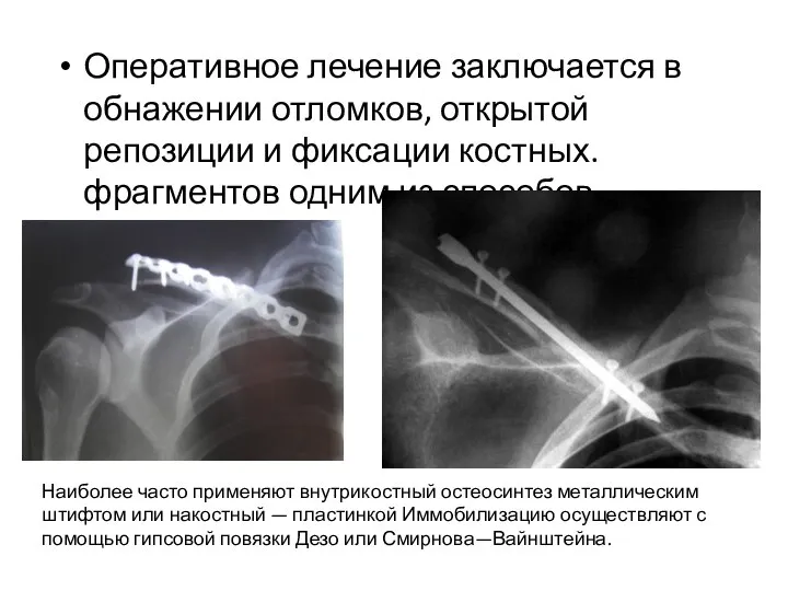 Оперативное лечение заключается в обнажении отломков, открытой репозиции и фиксации костных. фрагментов