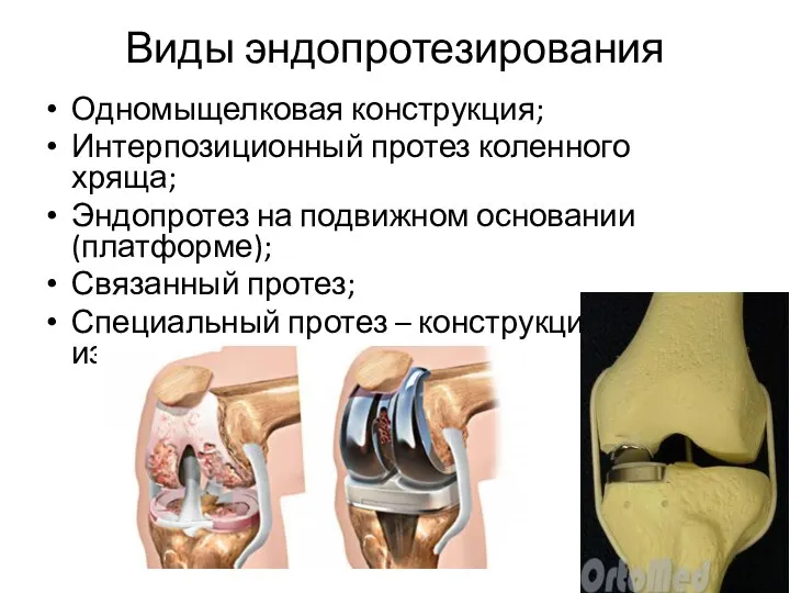 Виды эндопротезирования Одномыщелковая конструкция; Интерпозиционный протез коленного хряща; Эндопротез на подвижном основании