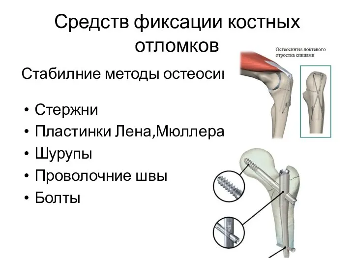 Средств фиксации костных отломков Стабилние методы остеосинза Стержни Пластинки Лена,Мюллера Шурупы Проволочние швы Болты