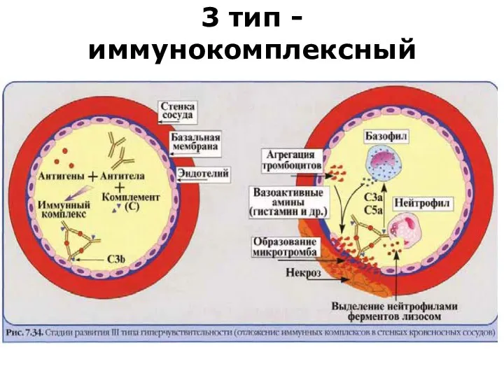 3 тип - иммунокомплексный