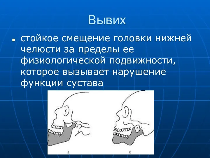 Вывих стойкое смещение головки нижней челюсти за пределы ее физиологической подвижности, которое вызывает нарушение функции сустава