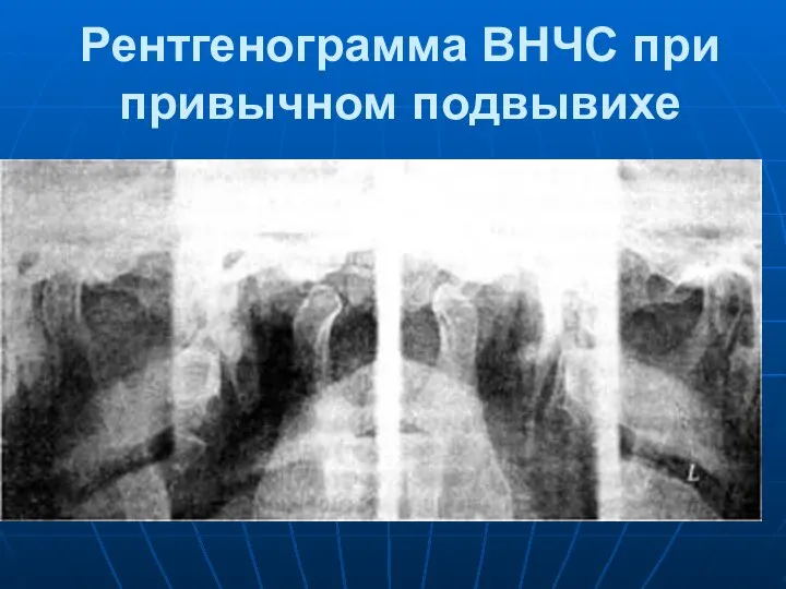 Рентгенограмма ВНЧС при привычном подвывихе